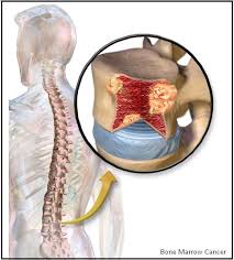 The doctor puts a needle into. Bone Marrow Cancer Symptoms Health Care Fix