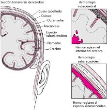 Cuando un aneurisma cerebral se rompe, el sangrado. Hemorragia Subaracnoidea Enfermedades Cerebrales Medulares Y Nerviosas Manual Msd Version Para Publico General