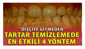 Diş taşı temizliği genellikle anestezi gerektirmeyen, uyuşturmadan yapılan bir uygulamadır. Disciye Gitmeden Tartar Temizlemek Mumkun Evde Tartar Temizleme
