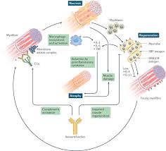 Image result for Myopathy