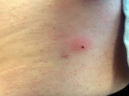 Zeckenstich Was Tun Das Mache Ich Borreliose Org
