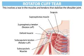 Image result for Rotator Cuff Rupture
