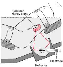 Colonoscopy | Nbgeneralsurgery
