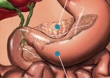 It is not known how it would be possible to prevent pancreatic cancer. How Would I Know If I May Have Pancreatic Cancer Oncology Nurse Advisor