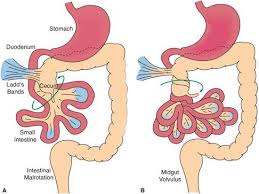 Image result for Midgut Volvulus
