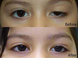 Mata berair dan produksi air mata berlebih dapat disebabkan oleh penyumbatan saluran air mata. Layanan Klinis Detail Surabaya Eye Clinic