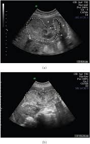Image result for Retained Placenta