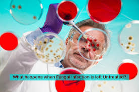 Maybe you would like to learn more about one of these? What Happens When Fungal Infection Is Left Untreated Ciron Drugs Blog