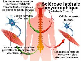 On estime que plus de 200.000 personnes dans le monde vivent aujourd'hui avec la sla. Sclerose Laterale Amyotrophique Maladie De Charcot Symptomes Traitement Definition Docteurclic Com