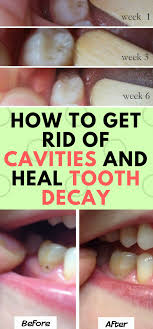 Methods to reverse tooth decay or a cavity. How To Heal Cavities In 2 Days Naturally Arxiusarquitectura