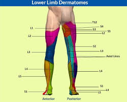 If Spinal Nerve Root S2 Is Pinched Will Symptoms Occur In The Leg In That Dermatomal Pattern Do Lumbar Disc Spinal Stenosis Surgery Herniated Disc Lower Back