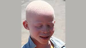 Pityriasis alba mainly affects children and adolescents aged 3 to 16 years, but may also arise in older and younger people. Hypopigmentation Causes Risk Factors Treatments More