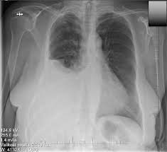 Image result for Hemothorax