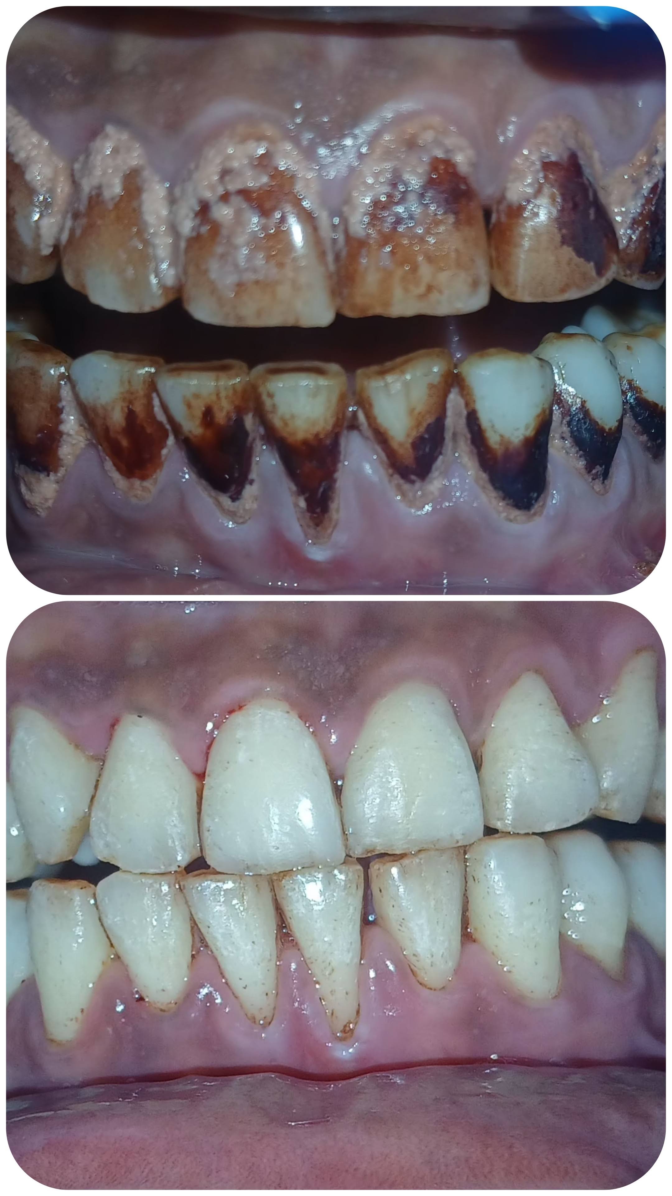 TEETH CLEANING product image