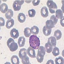Parasitized erythrocytes occlude capillaries in the brain. Peripheral Blood Smear Showing Ring And Schizont Stages Of P Vivax Download Scientific Diagram