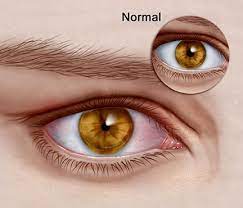 Horner S Syndrome Symptoms Causes And Treatment