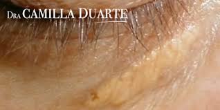 Image result for xantelasma
