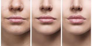 Superbly placed , what a stunning, natural transformation · 09/02/2022. Lips Rejuvenation Aesthetics Glow