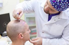 Cropped shot of doctor with syringe giving injection to man with alopecia looking at. Baldness Treatment Patient Suffering From Hair Loss In Consultation With A Doctor Preparation For Hair Transplant