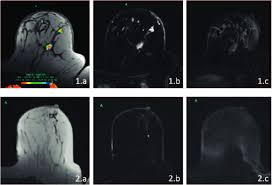 Inflammatory breast cancer usually does not produce a lump you can feel. Dynamic Contrast Enhanced Magnetic Resonance Imaging Dce Mri Download Scientific Diagram
