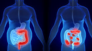 Hospitalizations for Inflammatory Bowel Disease Among Medicare Fee ...