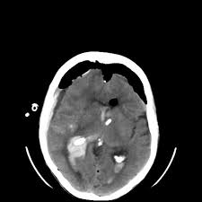 Mount Fuji Sign Is Seen On Cross Sectional Imaging And Implies Tension Pneumocephalus Is Present The Sign Refers To Radiology Frontal Lobe Medical Education
