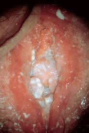 Image result for Vulvitis