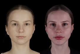 Em setembro estive em Denver (Colorado 🇺🇸) para participar de um  treinamento em prótese de ATM. Um treinamento para poucos cirurgiões e  muito@bem conduzido pela @zimmer_biomet e Dr. Craig Pearl. Momento de