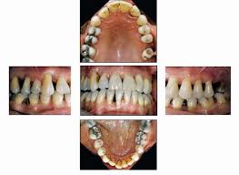 Periodontal Diagnosis In The Context Of The Bsp Implementation Plan For The 2017 Classification System Of Periodontal Diseases And Conditions Presentation Of A Patient With A History Of Periodontal Treatment British
