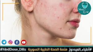 منصة_الصحة_الطبية_السورية ||• #أطباء_الميددوز 🔴 #حَب_الشباب !! 🔰 ما هو  حَب الشباب acne vulgaris ⁉️ 🔰واحد من أشيع الأمراض #الجلدية ، 80% من الشباب  أصيبوا به لهذا السبب يطلق عليه العد الشائع (common