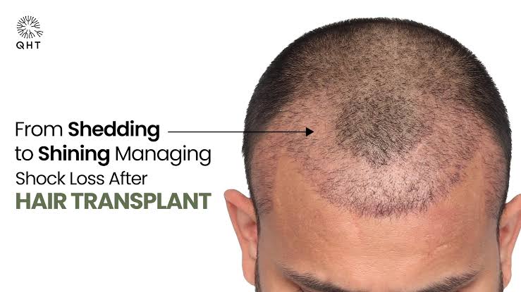 Shock Loss After Hair Transplant: Recovery & Timeline Guide
