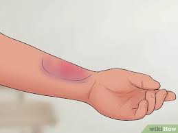 How does a broken or sprained wrist happen? How To Tell If Your Wrist Is Sprained 7 Steps With Pictures