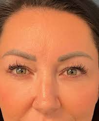 Eyelid Surgery Before and After Photos