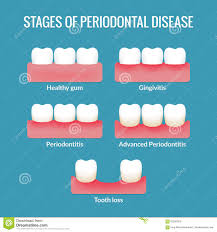 Periodontal Disease Chart Stock Vector Illustration Of