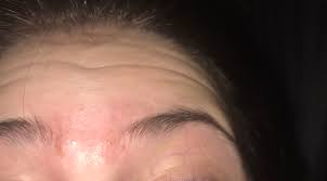 Maybe you would like to learn more about one of these? So Many Hard Lumps Between Eyebrows That Have Pus In Them General Acne Discussion Acne Org