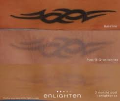 We are state licensed by the arkansas fish & wildlife. Tattoo Removal Fayetteville Nc Tattoo Design