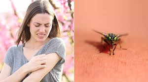 Image result for Fly Bite