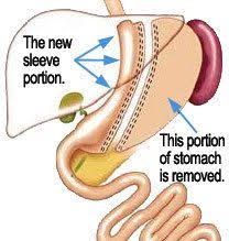 Top Ten Tips Before And After Gastric Sleeve Surgery Sleevesurgerydubai Http Www Weightlosssu Gastric Sleeve Surgery Sleeve Surgery Bariatric Surgery Sleeve