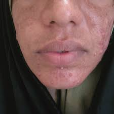 Frauen mit einem pcos haben wesentlich häufiger akne als der durchschnitt der bevölkerung in deutschland. Twenty Four Year Old Female With Resistant Acne Vulgaris Very Severe Download Scientific Diagram