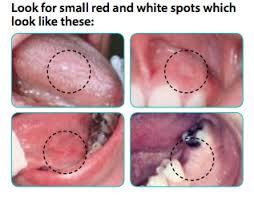 Image result for white cancer on tongue)
