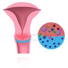 Linksys, a division of cisco systems, inc., is the recognized global leader in voip, wireless and ethernet networking for home, soho (small office, home office) and small business users. Deflagyn Vaginalgel Papbefund