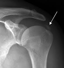 Image result for XRay Changes in Rheumatic Conditions