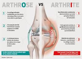 Pour les articles homonymes, voir genou (homonymie). Arthrose Arthrite Quelles Differences