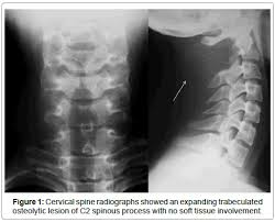 Since they are reactive bone lesions, these cysts can present with pain and swelling in the area. Aneurysmal Bone Cyst Of The Upper Cervical Spine In A Child A Case Report Scitechnol