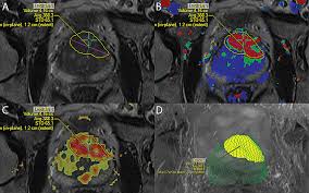Prostate cancer (staging) dr bahman rasuli and assoc prof frank gaillard et al. Prostate Cancer Diagnosis Improves With Mri Technology