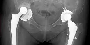 Operatia de proteza de genunchi nu este complicata, dar succesul operatiei depinde de experienta chirurgului ortoped care o realizeaza. Revizia Protezei De Sold Dr Robert Apostolescu Medic Ortoped