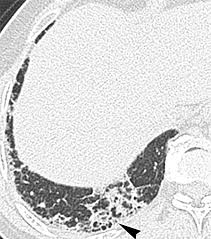Image result for Microscopic Polyangiitis