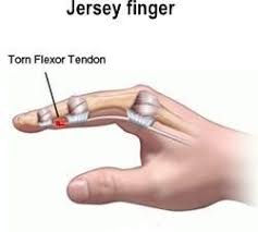 The flexor tendons in the arm, wrist and hand are in very close proximity to nerves and arteries. Jersey Finger Treatment For A Common Contact Sport Injury