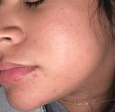 Recommendations for hormonal facial acne?