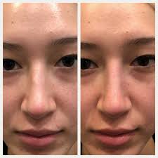 Before you even think about contouring your nose, you need to prep and prime your base for flawless application. The Non Surgical Rhinoplasty Everything You Need To Know